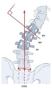 Apikal vertebra: Santral midsakral çizgiye uzaklığı enfazla olan vertebradır.