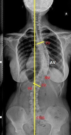Nötral vertebra: Eğriliğin alt ve üstünde, rotasyonu olmayan ilk vertebradır. Stabil vertebra: Midsakral çizginin tam ortasından geçtiği vertebradır.