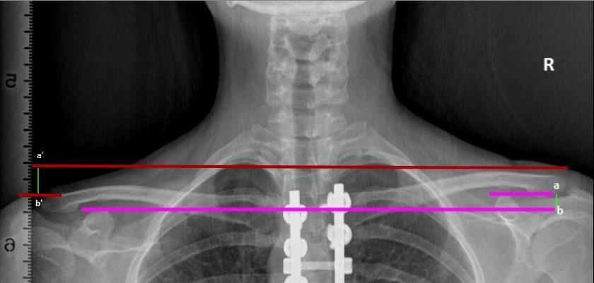DF : Apikal vertebra translasyonu Şekil 36 Koronoid yükseklik farkı ab ve radyolojik omuz yükseklik farkının a b radyografi üzerinden ölçülmesi T1 tilt:t1 vertebra end plate boyunca çizilen çizginin