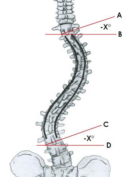 Şekil 38 Şematik olarak üst entrümante edilmiş vertebra (UIV) ve alt enstrümante edilmiş vertebra(liv) eğim açıları ölçümünün gösterilmesi (43). 2.1.