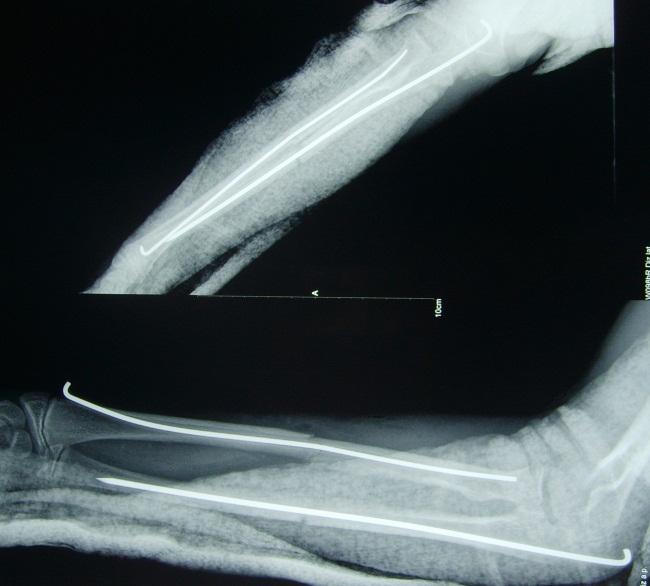 Hastaların hepsinde hem radius hem ulnaya intramedüller K telleri ile osteosentez yapıldı. Gustilo ve Anderson sınıflamasına göre 15 hastada tip1 açık kırık vardı.