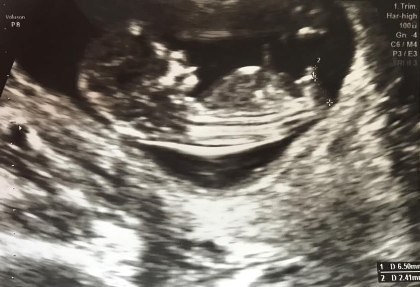Çalışmamızda; 11 ile 13 hafta 6 gün arası gebeliği olan ve birinci trimester tarama testi yapılan 217 gebede, transabdominal USG de fetüsün midsagital görüntüsü elde edilerek AGU ve GTU ölçüldü.