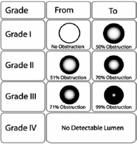 Buna göre; uzunluğu 1 cm den az olan, web-like stenozlar (ince halka şeklinde soluk membranöz alan) ve granülomlar basit, 1 cm den uzun, fibrozisin eşlik ettiği, kıkırdak hasarı ve malazinin eşlik