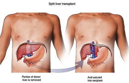 ) Retransplantasyon sonuçları kötü Rakela J, Vargas HE Liver Transpl 2002 Gane EJ.