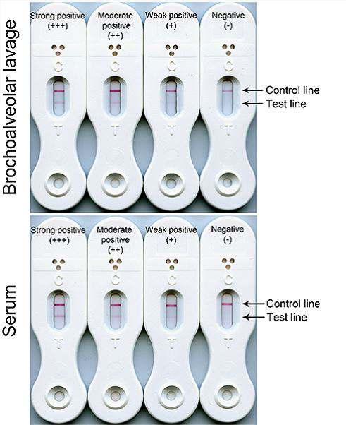 Lateral flow devices Uygulamada teknik uzmanlık gerek_rmez Hastabaşı tes_ olarak kolay ve hızlı bir test Aspergillus glukoprotein