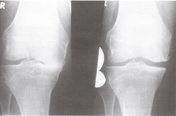 Şekil 2.7.1 Varus/valgus stres radyografisi Hasta varus deformitesi olan dizinin üstünde durduğunda vücut ağırlığı lateral eklem yüzeyini başka yöne çekme eğilimi gösterir(39,40).