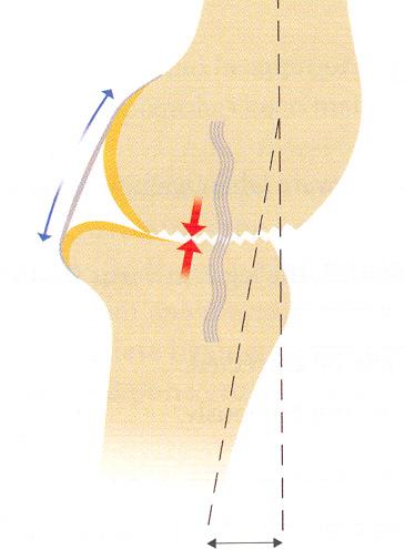 Çapraz bağlar, sagittal düzlükte tibia üzerindeki femurun normal rollback yapısını korumaktadır ve bu yüzden ekstansiyondaki hasarlı temas noktaları(anterior tibial plato ve medial femoral kondilin