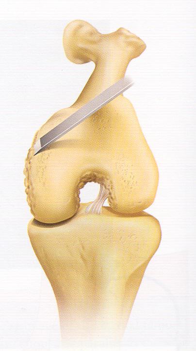 2.8.3. Osteofitlerin eksizyonu: Medial femoral kondil ve interkondiler çentik kenarındaki büyük osteofitler çıkarılmalıdır(şekil 2.8.3a).
