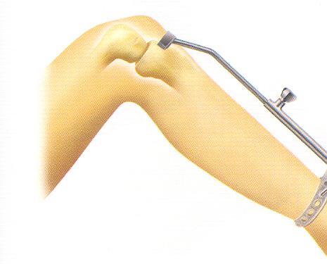 Bıçak medial femoral kondilin lateral kenarına karşı durmalı ve interkondiler çentiğin içine doğru bastırılmalıdır.