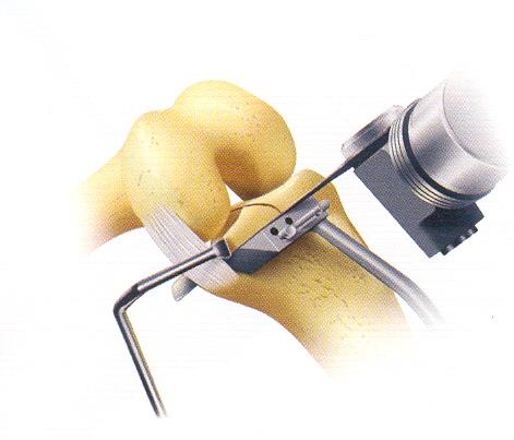 Kesilen plato geniş osteotom ile manivela yapılıp çıkarılır. Posteriordaki yumuşak doku bağlantıları bıçak ile kesilir. Medial menisküsün posterior hornu çıkarılır.