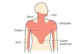 Eğer göğüs ağrısına; Dispne Terleme Bulantı ve/veya kusma eşlik ediyorsa iskemi riskinin iki kat daha fazla olduğuna işarettir.