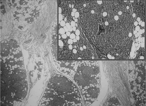 fiekil (PS-82): Parotis bezi biyopsi örne i, H&E boyama, epiteloid hücre içeren non-kazeifiye granülomlar.