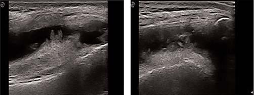 a fiekil (PS-85): Ultrasonografi, (a) sa diz longitudinal ve (b) transvers görüntü. Prefemoral ya dokusuna göre hipo-izoekoik sinoviyal hipertrofi. a b fiekil 2 (PS-85): MRG.