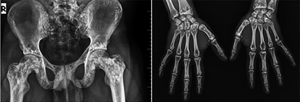 Olgu : 22 yafl nda erkek hasta, yaklafl k 0 y l önce bafllayan el parmaklar ve kalça ekleminde a r flikayeti ile baflvurdu.