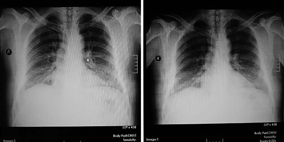 RA l hastalarda pulmoner enfeksiyon ve ilaç toksisitesi s k görülmekle birlikte romatoid artritin primer sorumlu oldu u akci er parenkim, hava yolu ve plevra hastal klar oldukça yayg n olarak
