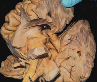 Pulvinar talaminin arka yüzeyi lateral Şekil 5: Süperior ve inferior kollikulus arasından geçen aksiyel kesitte beynin inferiordan görünüşü: İkp, inferior koroidal nokta.