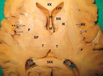 Kaudat Nükleus Kaudat nükleus lateral ventrikül duvarının önemli bir kısmını yapar, talamusu C şeklinde saran yapıdır.
