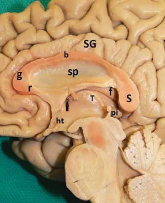 ilerleyerek atrium, oksipital horn ve temporal hornun tavanını oluşturur. Oksipital radyasyon liflerini temporal horndan ayırır (1).