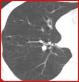 Şekil 2B : Toraks BT Abdomen ultrasonagrafisinde bilateral grade 1-2 böbrekler görüldü, abdominal magnetik rezonans görüntüleme (MRG) sonuçları normaldi.