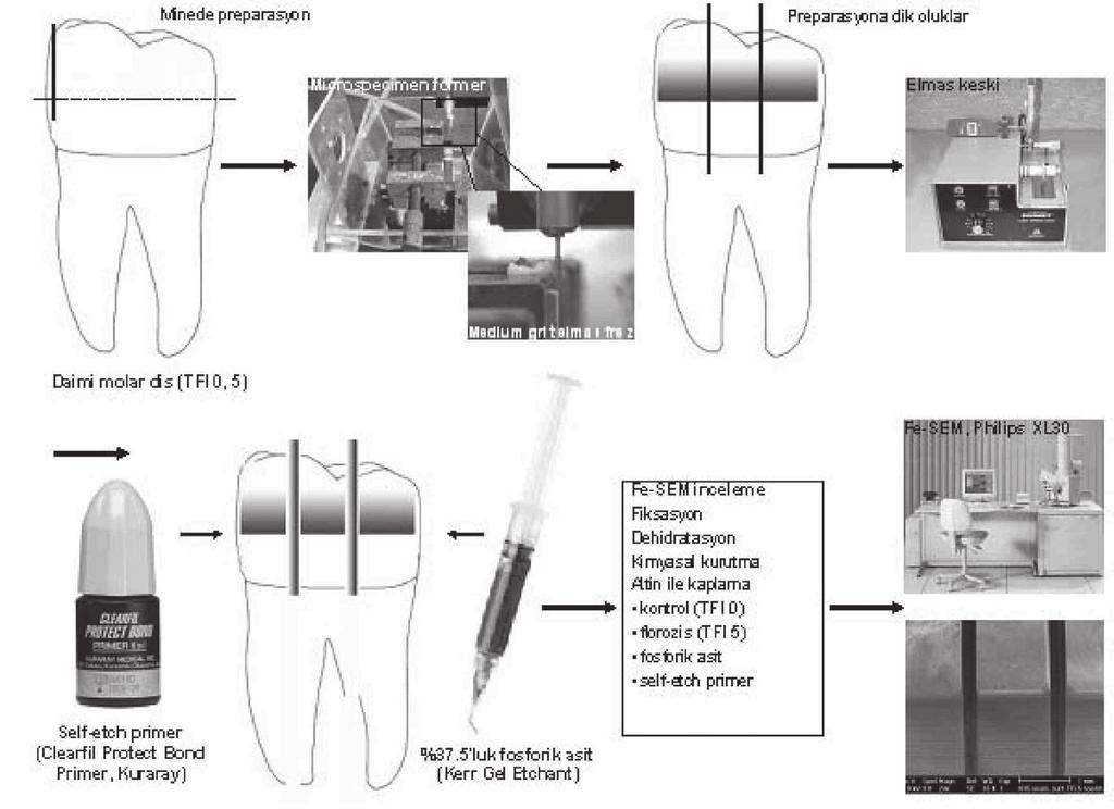 67 Asitleme modeli Örneklerin hazırlanması Bu morfolojik çalışma için 2 adet florozisli (TFI 5) ve 1 adet normal (TFI 0) daimi molar diş kullanıldı.