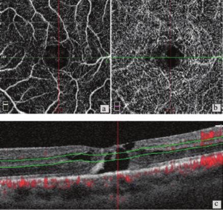 c) Aynı gözün b-scan optik koherens tomografi görüntülemesi normal sınırlarda patolojinin vasküler olmadığı görüşünü desteklemektedir.