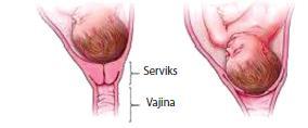 1: Tuşe ile servikal açıklık kontrolü Uterus kontraksiyonları gebe tarafından ağrı olarak hissedilir.