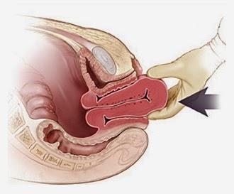 uterus subinvolüsyonu uterusun gebelik öncesi normal boyutlarına dönmesinde duraklamayı ifade eder. Plasenta retansiyonu ve endometrit gibi nedenlerle ortaya çıkabilir.