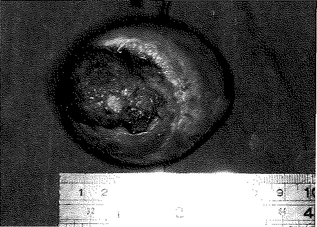 HASTALAR VE TEKNİK 1994 2001 yılları arasında 9 meningomyelosel olgusunda izlenen geniş lumbosakral defekt bilateral interconnected latissimus dorsi-gluteus maksimus kasderi Hepleriyle rekonstrükte