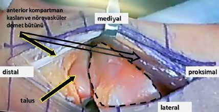Tibia pilon kırıklarının tedavisinde kullanılan cerrahi yaklaşımlar 237 Şekil 4. Anterolateral yaklaşılımın kadavra disseksiyonu görüntüsü.