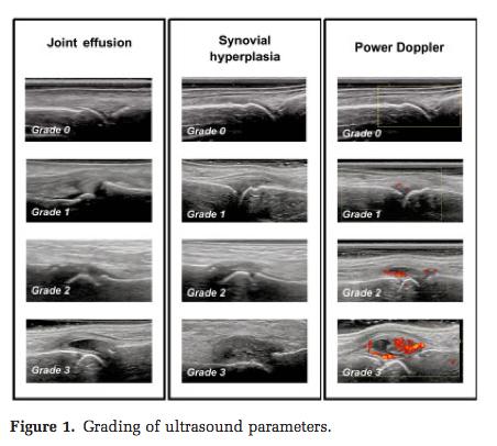Şekil-2: Eklem efüzyonu, sinoviyal hipertrofi ve power