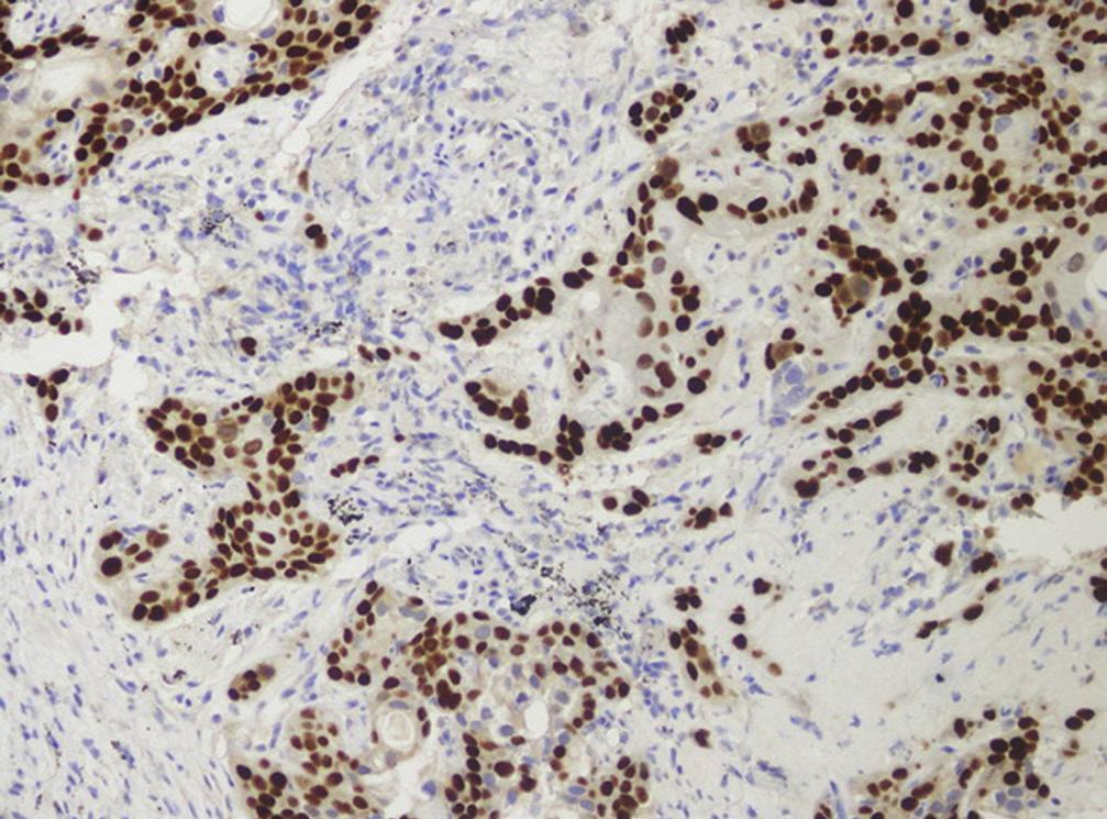 Toraks Cerrahisi Bülteni 2017; 10: 31-39 altında yer alan bazaloid, berrak hücreli karsinom ve rabdoid fenotipli büyük hücreli karsinom alt tipleri kaldırılmış, büyük hücreli nöroendokrin tümör alt