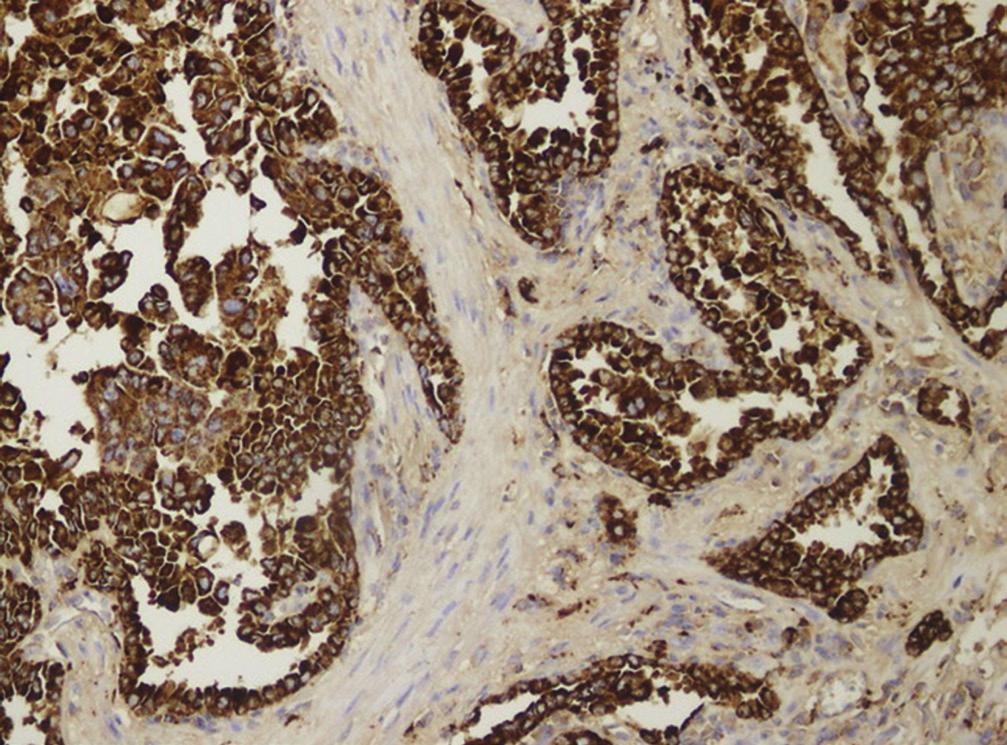 Nadir Görülen Tümörler Sınıflandırmaya dahil edilen nadir tümörler; NUT gen rearrangement gösteren NUT karsinomu, EWSR1-CREB1 translokasyonu gösteren pulmoner miksoid sarkom, EWSR1 gen rearrangement