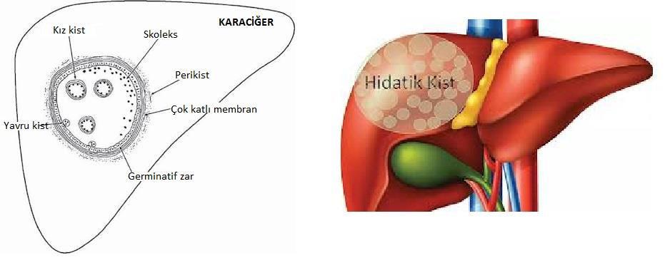 Klinik Kara iğer tutulu u Kist çapı > ise kli ik yakı alar ve ulgular izle e ilir.