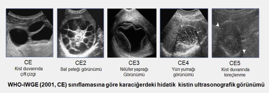 Tip 1: Basit kara iğer kisti e e zer, anekoiktir, sade e sıvı topla ası vardır, çift çizgi işareti vardır. (Aktif kist) Tip 2: Kist içi de, al peteği i a dırır tarzda çok sayıda öl eler bulunur.