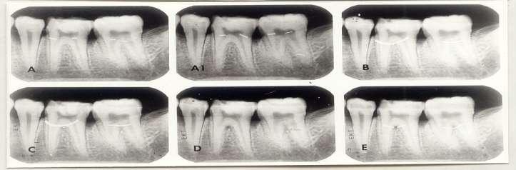 Mandibular molar dişlerde furkasyon problemlerinin radyografik teşhisi Test radyografileri Furkasyon problemi yok Kemik