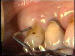 periodontal sonda Naber furkasyon