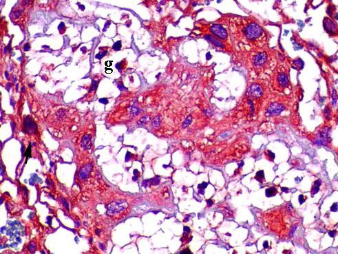 Şekil 36. Hipertiroidi grubu plasenta labirent alanında görülen pozitif anti-sparc boyaması, (immün peroksidaz, Hematoksilen zıt boyaması- g: glikojen hücresi, uzun başlı ok; sitotrofoblast), X400.