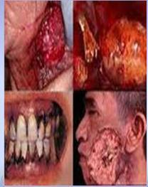 Tütün dumanı, diş eti hastalıklarına ve diş çürümesine sebep olabilir.