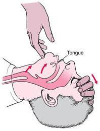Havayolu Anatomisinde Önemli Noktalar Anestezi uygulaması ile birlikte en büyük sorun üst havayolunun kas tonusundaki azalmadır. Bu azalma ile dil ve epiglot arkaya düşer.