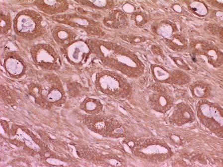30 Tümörün invazyon gösterdiği sınırda, tümör hücrelerini saran FN-pozitif liflerin perisellüler demarkasyon