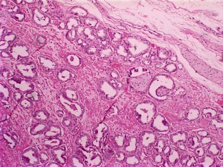 9 Prostat Adenokarsinom Tanısı Için Gerekli Histolojik Yapısal Bulgular: Karsinomatöz asinerlerin düzensiz şekilde infiltrasyon göstermesi Asinilerin stromada kas liflerini yararak infiltrasyon