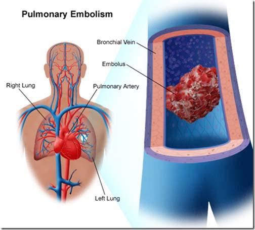 Öğrenim Hedefleri Pulmoner emboli (PE) şüphesi olan hastada başlangıçrisk sınıflaması, Klinik tahminde