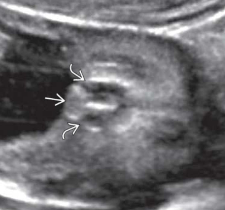 Şiddetli hipospadias: 2 boş skrotal kese arasında küçük bulböz tulip sign ; 3
