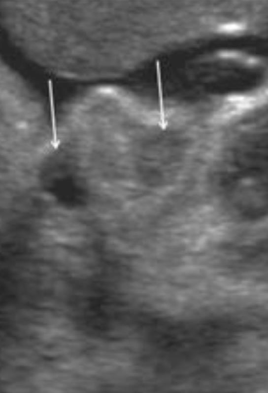 Penoskrotal hipospadias tulip işareti Kısalmış penis her iki skrota