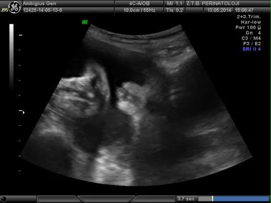 The confirmation of the diagnosis of ambiguous genitalia with 4D ultrasonography A 18 yr primigravid at 34 weeks with IUGR Four weeks growth retardation with normal amniotic volume and Doppler