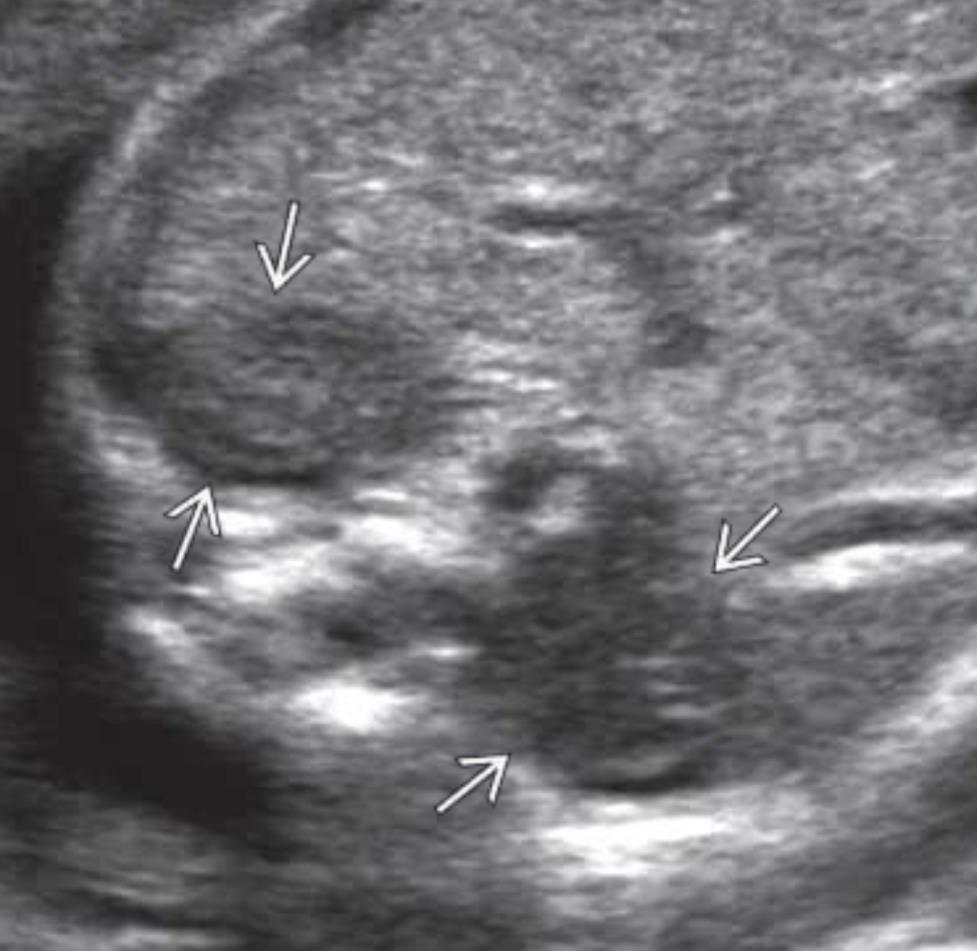 Adrenal glandların aksiyel ultrasonografisi: büyümüş globüler adrenal glandlar, KAH
