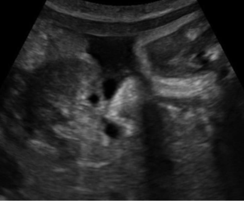 A case of prenatal diagnosis of fetal bladder exstrophy and ambigous genitalia A 26-yr G1P0