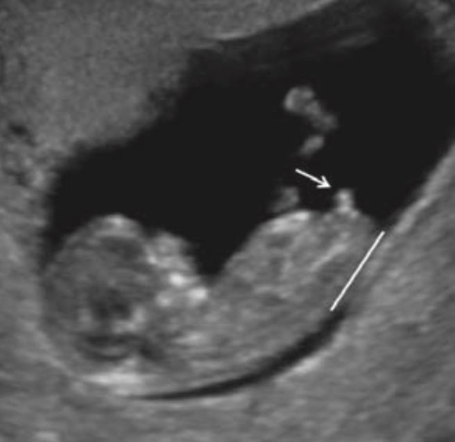 İlk trimester erkek fetus.