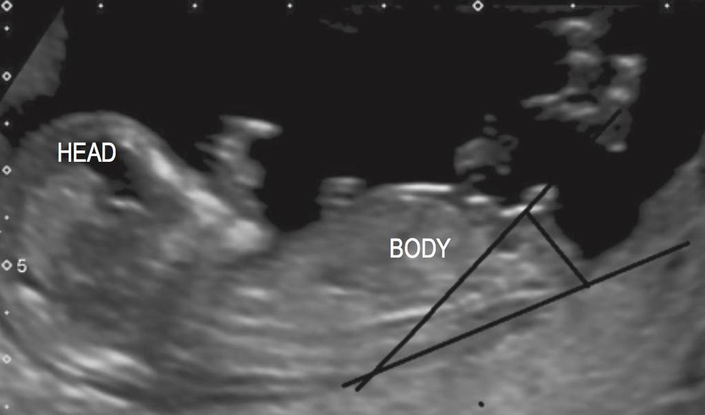 Fetal cinsiyet: lumbosakral deri yüzeyinden geçen horizontal çizgi ile genital tüberkül (midsaggital planda) arasındaki açı açı >30 ise: erkek açı genital