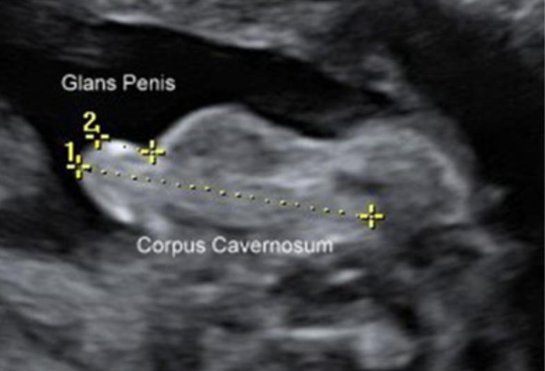 Prenatal sonographic evaluation